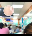 他克莫司软膏长期抹脸可以吗
